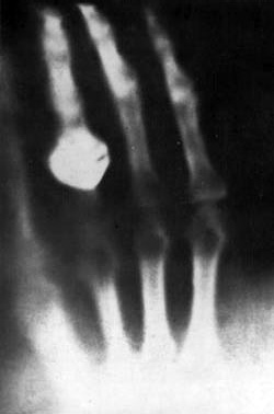 Bertha Röntgens hand